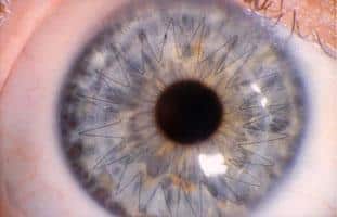 Closeup of an Eye That Has Had Corneal Cross-linking Performed