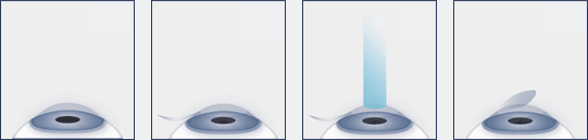 eye ball depictions through surgery