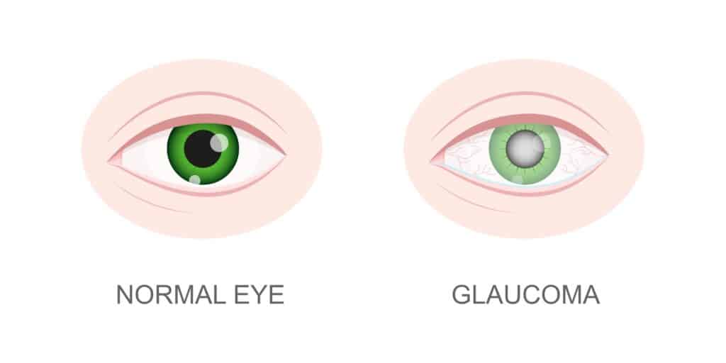glaucoma vs normal eye