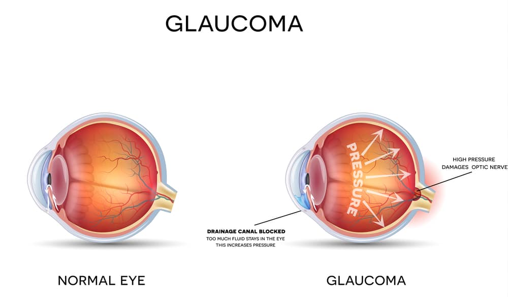 healthy eye vs glaucoma eye