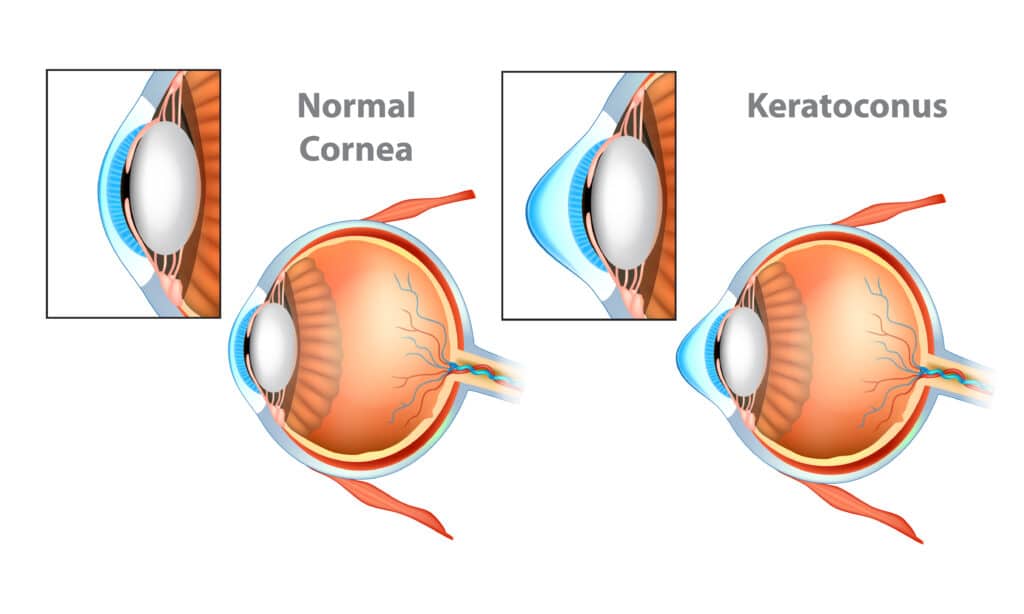 Keratoconus vs Normal Eye